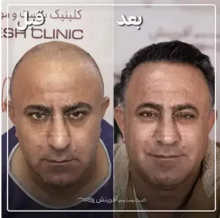 نمونه کار کاشت مو