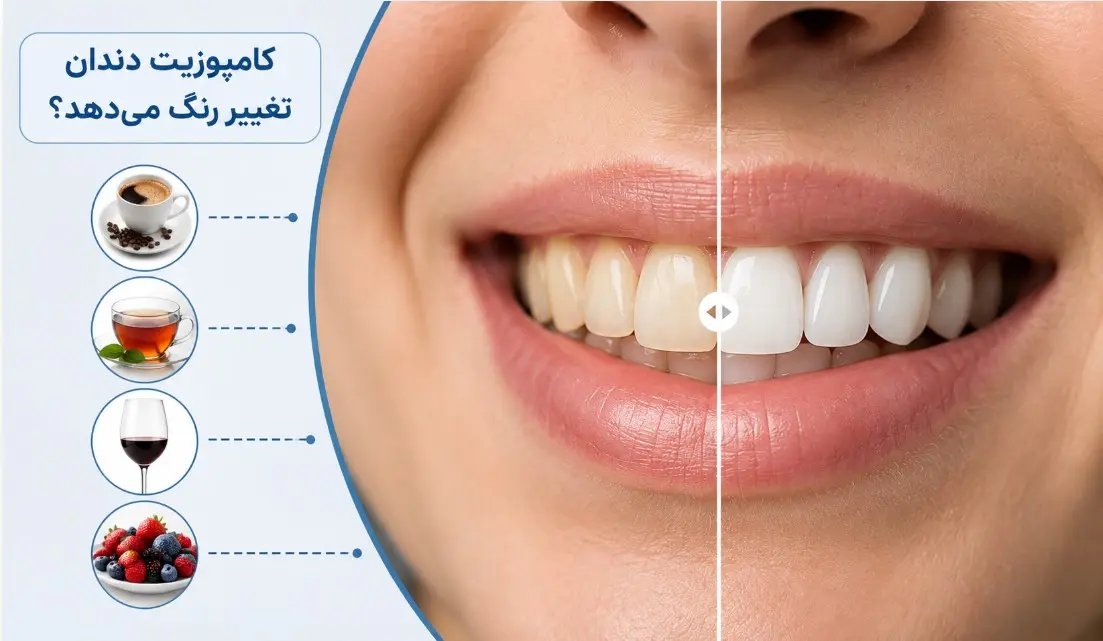 آیا کامپوزیت دندان تغییر رنگ می‌دهد؟