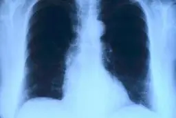  کروناویروس تهدیدی بزرگ برای بیماران ریوی