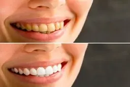  راه‌ های آسان برای سفید کردن دندان ها 