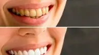  راه‌ های آسان برای سفید کردن دندان ها 