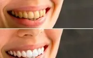  راه‌ های آسان برای سفید کردن دندان ها 