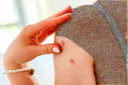 راههای پیشگیری از پاپول + درمان 