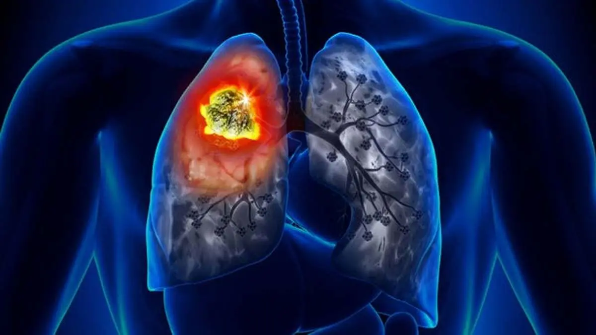 
علت بروز سرطان ریه در افراد غیرسیگاری چیست ؟
