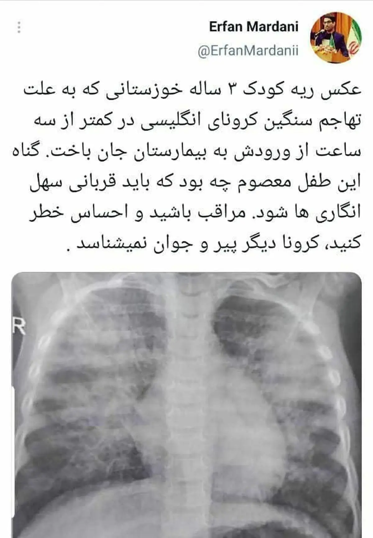 کودک ۳ ساله مبتلا به کرونا در خوزستان، کمتر از ۳ ساعت پس از رسیدن به بیمارستان جان باخت‌