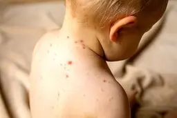 شیوع «تب گوجه‌فرنگی» | این علائم را جدی بگیرید