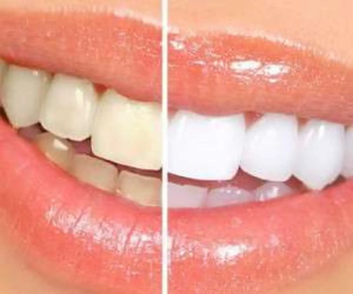 ۷ روش خانگی برای سفید کردن دندان
