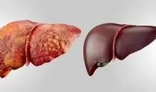 علائم مهم کبد چرب را بشناسید