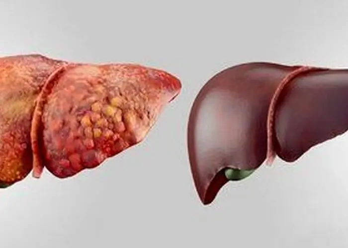 علائم مهم کبد چرب را بشناسید