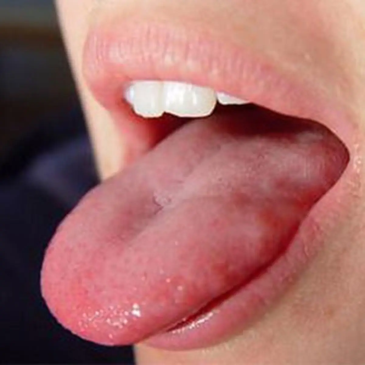 4 روش برای تسکین سوختگی زبان و دهان