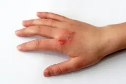 درمان سوختگی دست در یک چشم بر هم زدن!