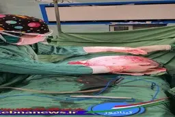 خارج کردن توده 8 کیلوگرمی از شکم بانوی ۶۵ساله