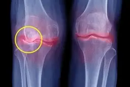 آسیب‌ های مفصلی ناشی از اضافه وزن، یکی از اثرات کروناست 