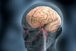 سکته مغزی رابطه مستقیم با گروه خونی انسان دارد