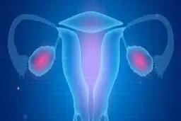 حفظ باروری در زنان دارای سرطان تخمدان