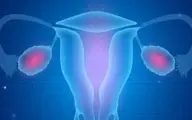 حفظ باروری در زنان دارای سرطان تخمدان
