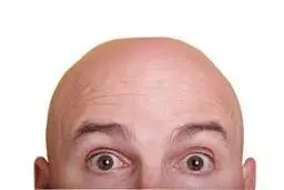 احتمال مبتلای مردان طاس به کرونا بیشتر است 