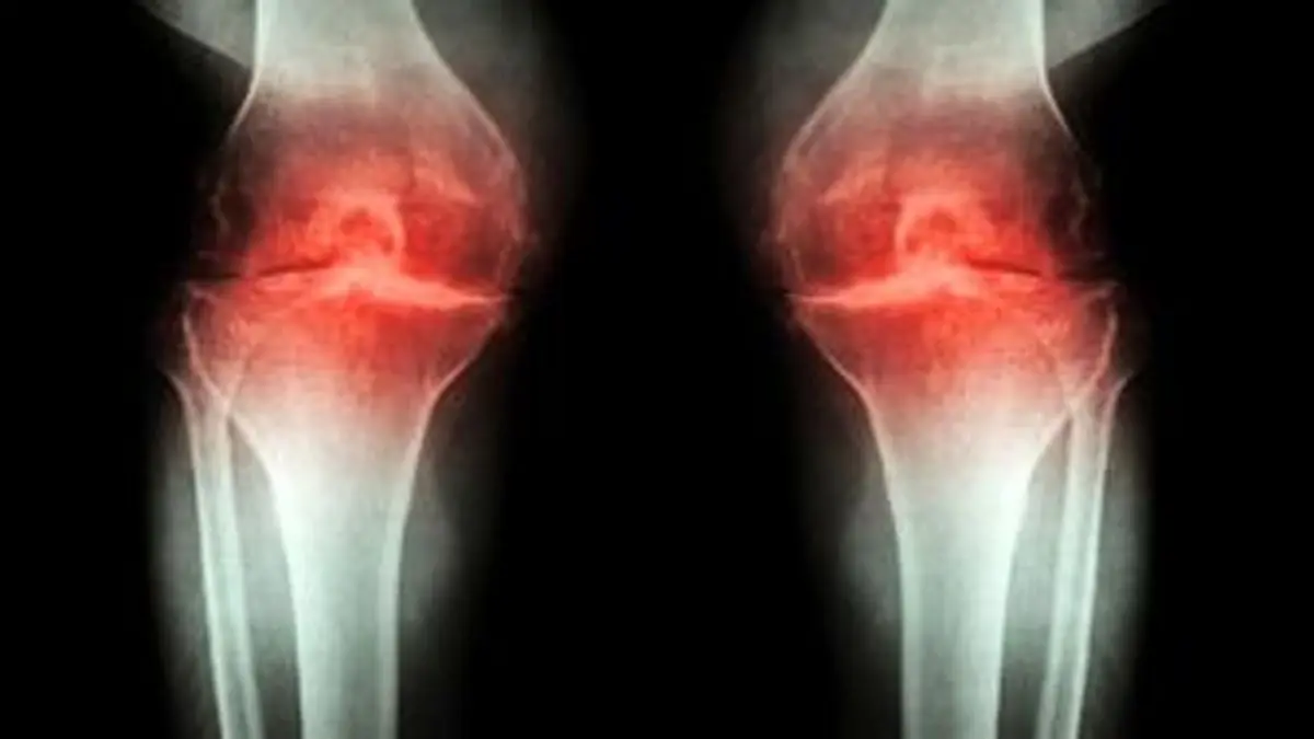 روش درمان آرتروز با شناسایی سیگنال درد 