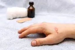 درمان سوختگی‌های ساده با این روش‌ها | سوختگی‌های ساده را به راحتی در خانه درمان کنید