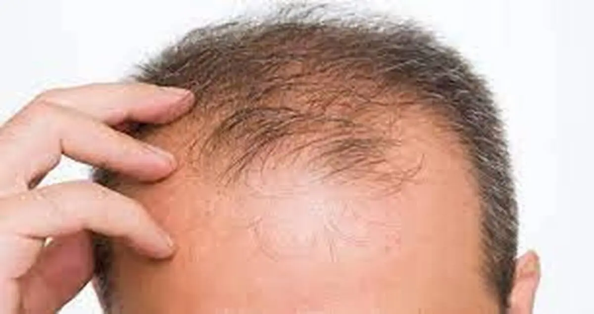 علت طاس شدن سر، تقصیر ژن مادر است یا پدر؟ 
