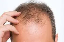 علت طاس شدن سر، تقصیر ژن مادر است یا پدر؟ 