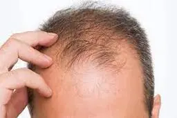علت طاس شدن سر، تقصیر ژن مادر است یا پدر؟ 