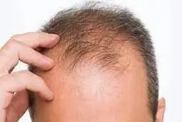علت طاس شدن سر، تقصیر ژن مادر است یا پدر؟ 