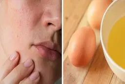 چطور منافذ پوست را ببندیم ؛ ۱۵ روش خانگی و کم هزینه برای داشتن پوستی زیبا