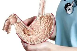 نشانه  های مبتلا به سرطان معده |چه موقع به پزشک مراجعه کنیم؟