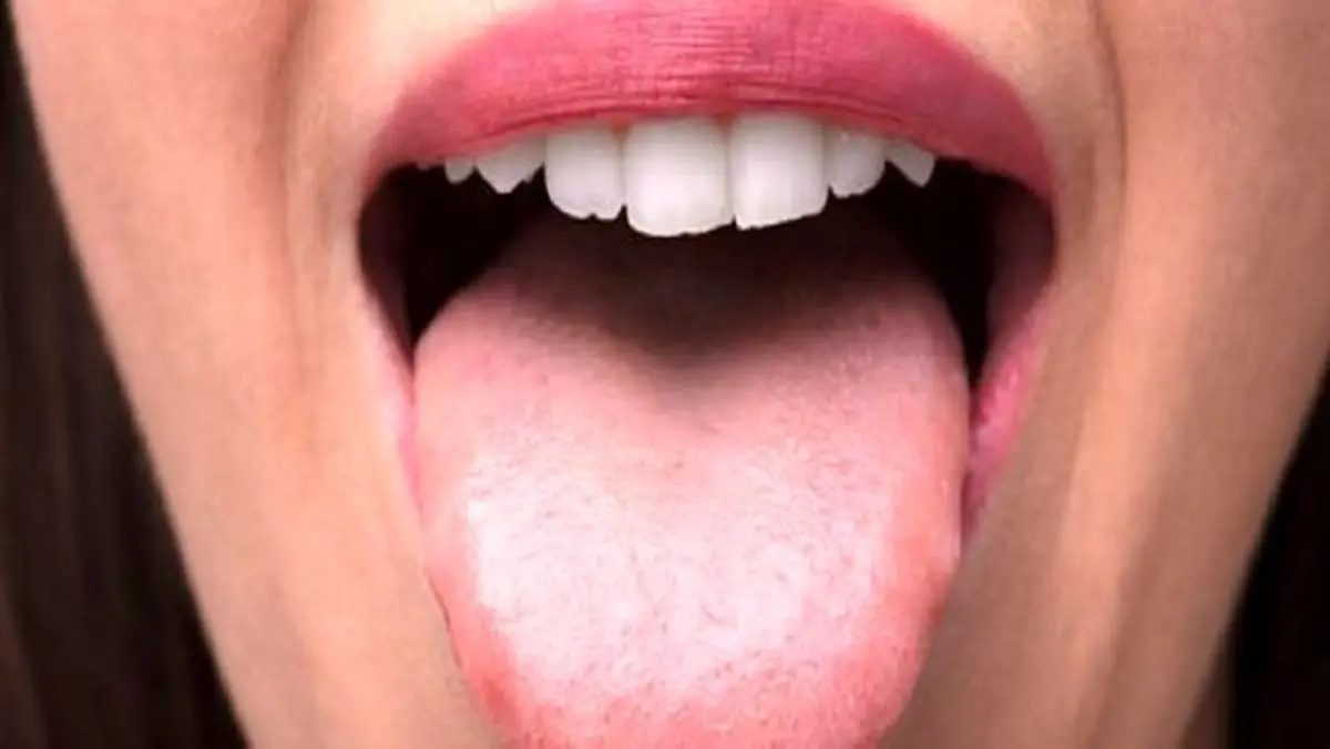 سرطان زبان را با این ۳ نشانه تشخیص دهید