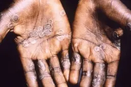 پشت پرده شیوع آبله میمون | هشدار چندین ساله دانشمندان