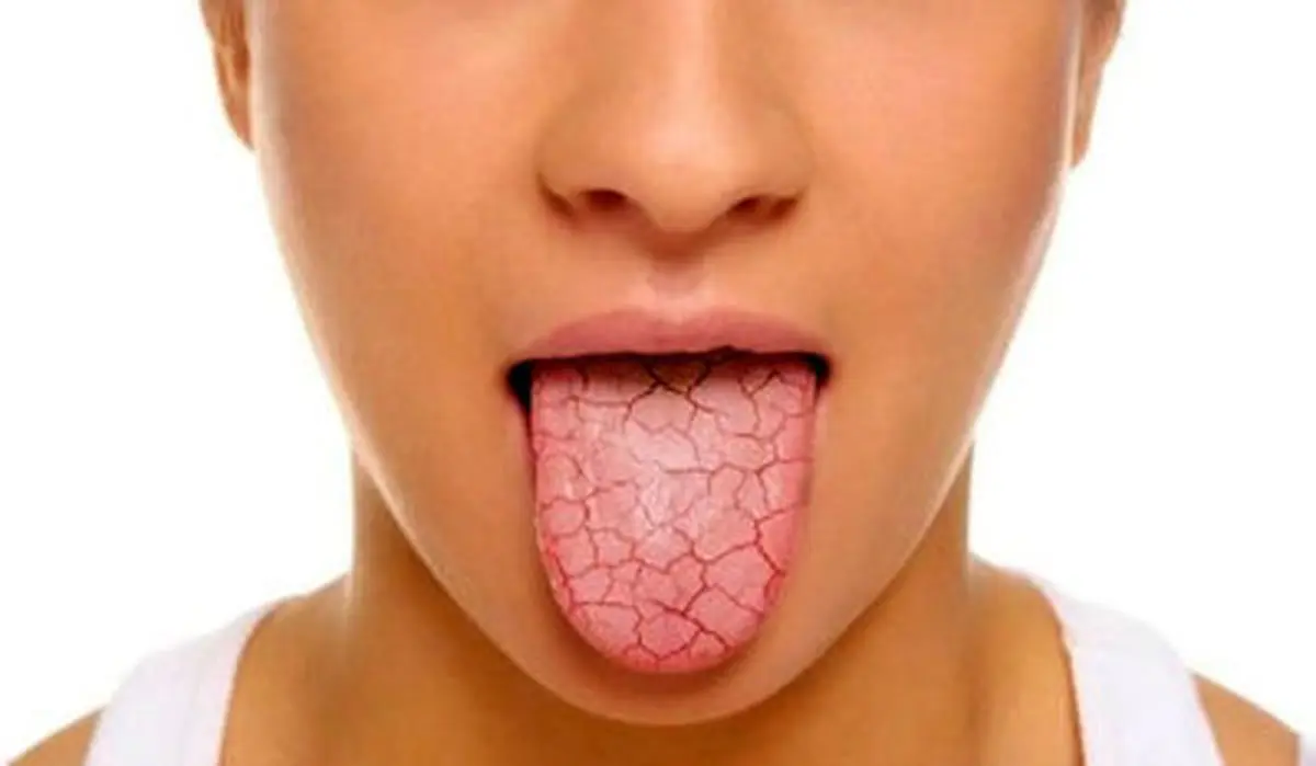 دلیل خشکی دهان چیست؟