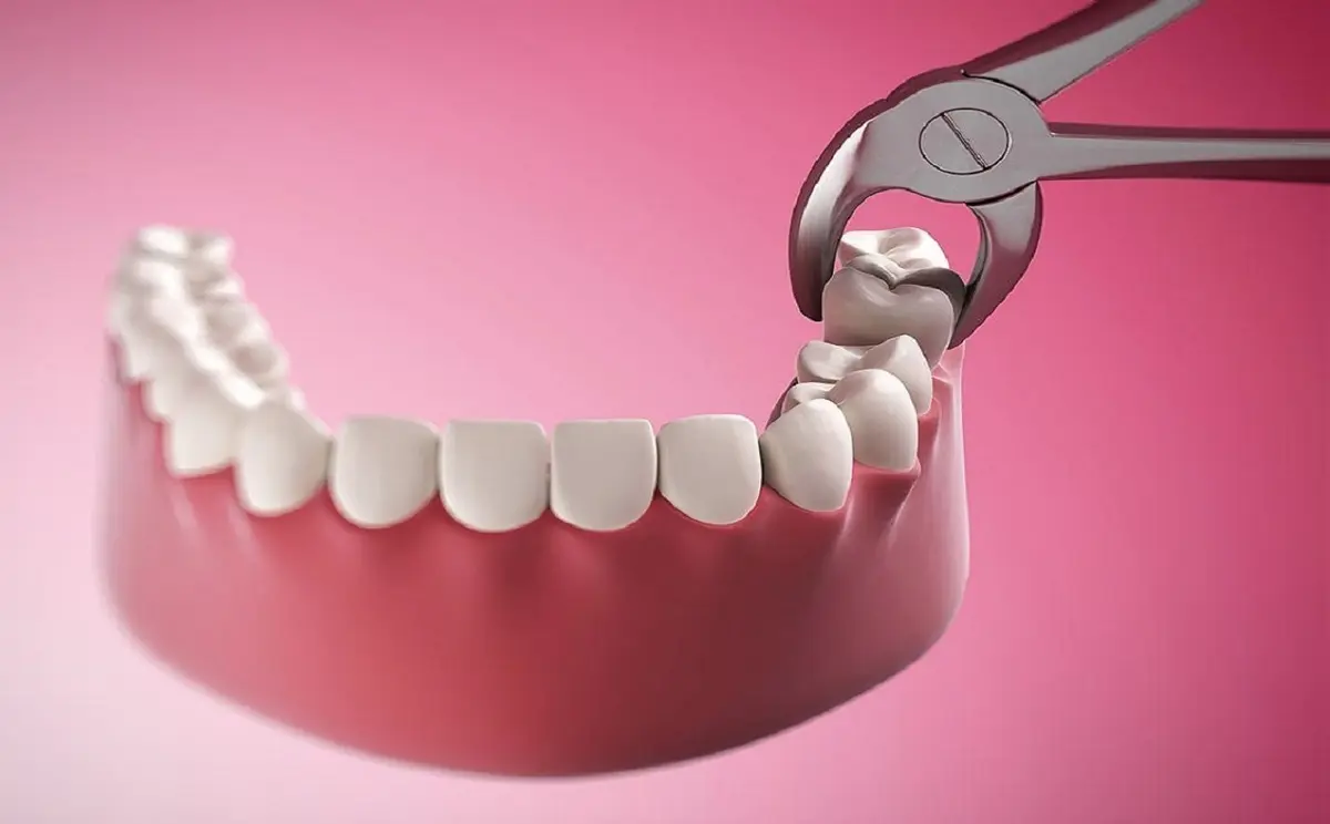 مقاومت عجیب دندان عقل در برابر فشار دستگاه پرس!+ویدئو
