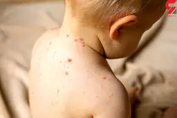 درباره سرخک چه می دانید؟