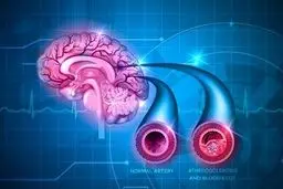 داروهای ضدتهوع ریسک سکته مغزی را افزایش می دهند 