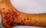 علامتی دردناک در پوست که نشانه سرطان است 