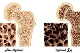 درمان پوکی استخوان + ویدئو 