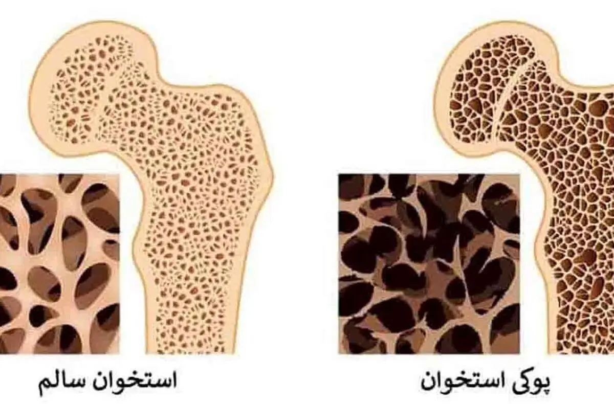 درمان پوکی استخوان + ویدئو 
