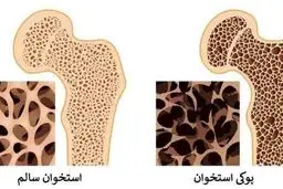 راه‌های فرار از پوکی استخوان 