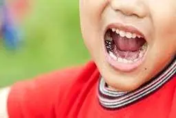  علل پوسیدگی دندان های کودکان