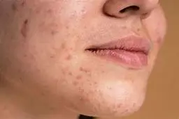 با جوش های صورتتان خداحافظی کنید |  با این ترفند به جنگ جوش‌هایتان بروید