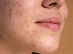 خداحافظی با جوش سر سیاه با این ماسک خونگی | درمان جوش سیاه به روش طبیعی +ویدئو