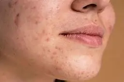 خداحافظی با جوش سر سیاه با این ماسک خونگی | درمان جوش سیاه به روش طبیعی +ویدئو