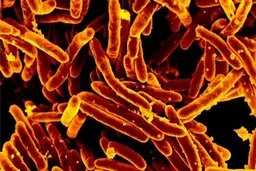 ویروس کروناعامل افزایش موارد ابتلا به سل در جهان