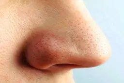 از بین بردن جوشای سر سیاه با کمک لیمو +ویدیو