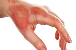 اگه دستت سوخت با این روش سریع سوزشش رو بنداز! | دیگه به هیچ وجه جاش نمیمونه! 