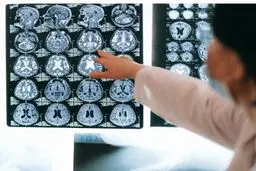 کووید-۱۹ تاثیر مشابه آلزایمر بر مغز دارد