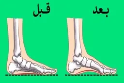 با چند تمرین ساده مشکل صافی کف پا را کاهش دهید