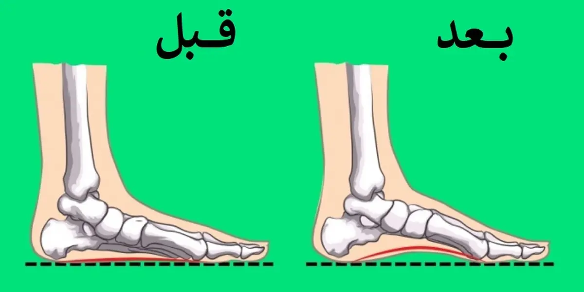 با چند تمرین ساده مشکل صافی کف پا را کاهش دهید