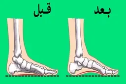 با چند تمرین ساده مشکل صافی کف پا را کاهش دهید
